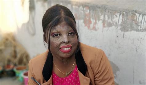 Acid attack survivors hone artistic skills, to support other survivors - Hindustan Times