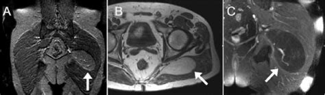 MRI of intramuscular hibernoma. (A) Coronal MRI survey image showing ...