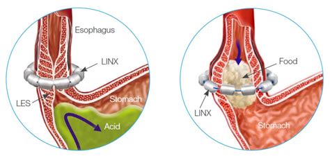 Linx Device for Acid Reflux - Comanche County Memorial Hospital