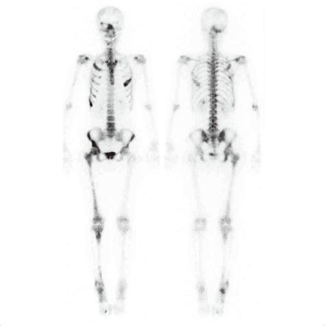 The baseline whole body bone scan. Abnormal increased uptake was ...