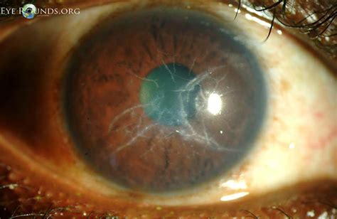 Atlas Entry - Lattice corneal dystrophy