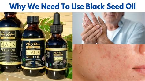 Why We Need to Use Natural Black Seed Oil for Our Skin (missarlenes.com) - YouTube