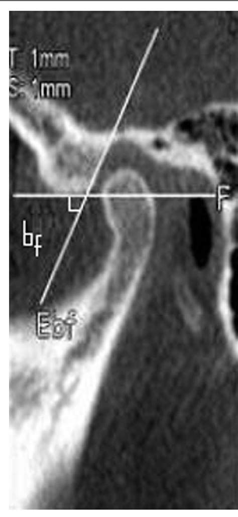 Figure 2 from Radiological examination of the articular eminence morphology using cone beam CT ...