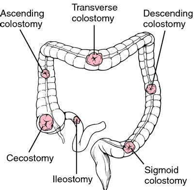 Types of Stoma | Nursing school survival, Nursing school, Surgical nursing