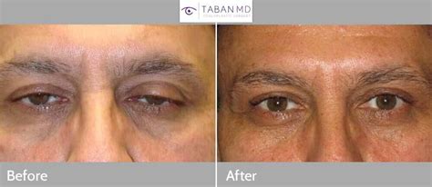 Eyelid Ptosis Before and After Gallery | Taban MD