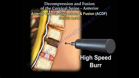 Cervical Spine ,Decompression And Fusion . - Everything You Need To Know - Dr. Nabil Ebraheim ...