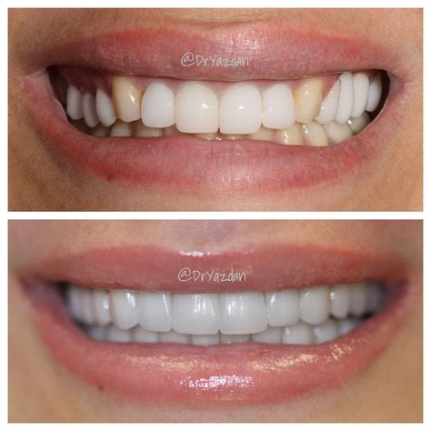 Full mouth reconstruction using veneers, crowns, bridges. Notice the more natural end result ...