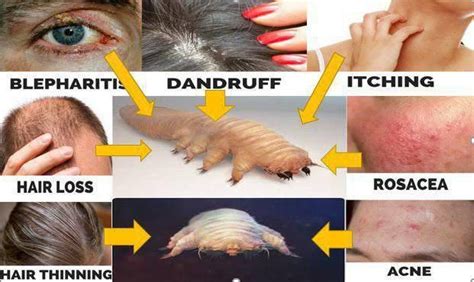 Most Hair Loss And Skin Problems Are Linked To Mites, We Offer A ...