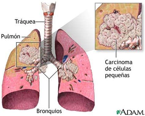 Cáncer pulmonar de células pequeñas - EcuRed