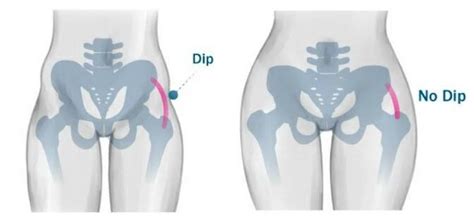 Hip Dips and How MediCramp Muscle Relief Meds Enhance Exercise ...