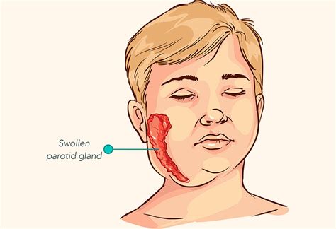 Mumps in Kids – Reasons, Signs & Treatment