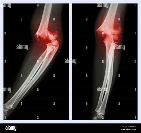 Dislocación De Fractura De Codo