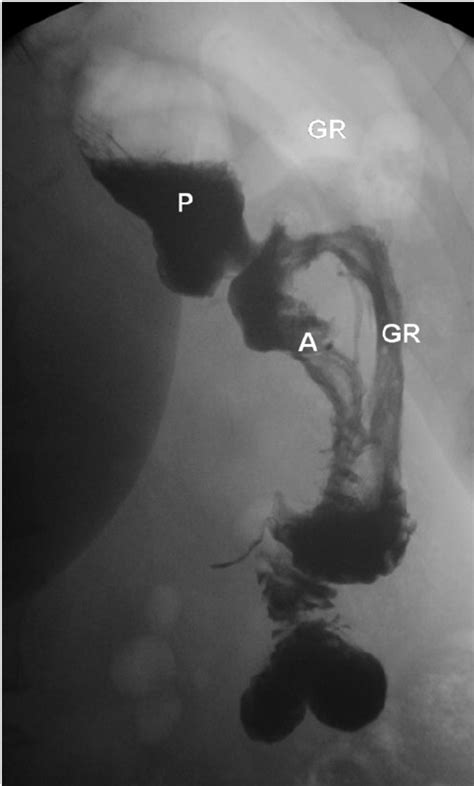 Contrast study demonstrating gastrogastric fistula; | Download Scientific Diagram