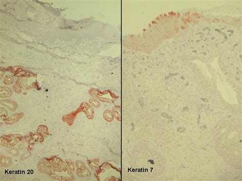 Intestinal heterotopia in urethral caruncle