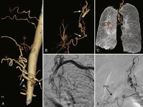 Bronchial Arteries | Radiology Key