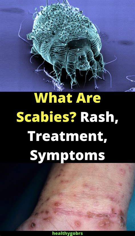 What Are Scabies? Rash, Treatment, Symptoms, Pictures - healhty and tips