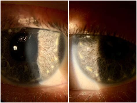 Iris Brushfield spots, commonly found in Down syndrome patients : r/optometry