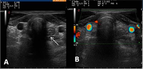 Midline Ectopic Thyroid Mimicking as a Thyroglossal Duct Cyst - Manju Bala Popli, Arun Chaudhary ...