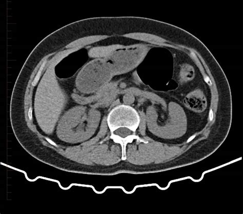 Lesion On Kidney CT Scan