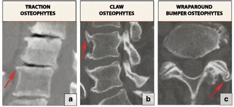 Osteophyte - Physiopedia