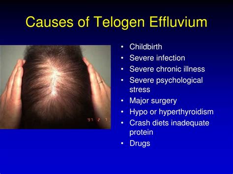 What Is Telogen Effluvium? Causes Signs And Treatment | Justinboey