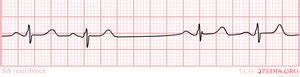 Sino-atrial exit block - ECGpedia