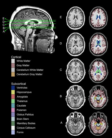 Axial Brain Mri