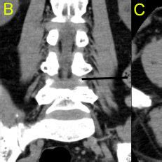 Transforaminal epidural contrast injection test to demonstrate that the... | Download Scientific ...