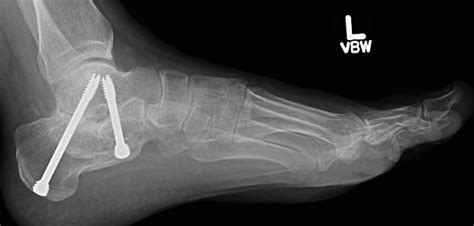 Subtalar Fusion - Protocol — Dr. Andrew Marsh