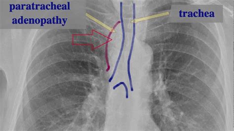 solitary paratracheal adenopathy on a chest radiograph - YouTube