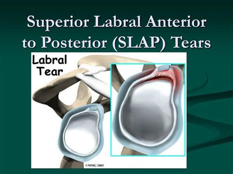 Anterior Labral Tear Hip