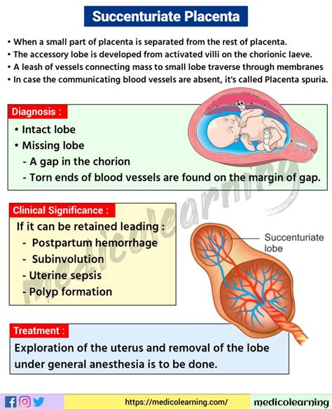 Succenturiate placenta – MedicoLearning