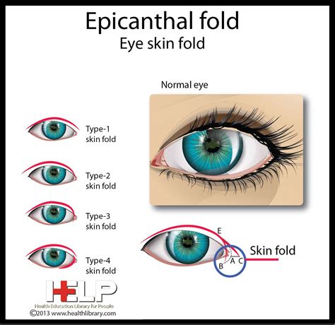 Epicanthal Fold | Epicanthic fold, Mthfr, Awareness