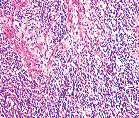 Rhabdomyosarcoma pathophysiology - wikidoc