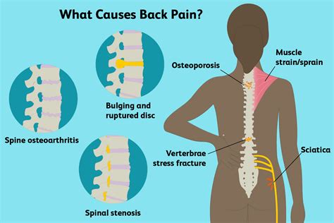 Lower Back Pain Causes - Chronic Lower Back Pain - Chronic Lower Back ...