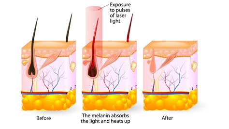 How Does Laser Hair Removal Work? - London Premier Laser & Skin Clinic