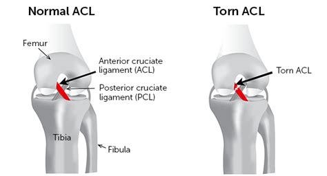 ACL Grafts: Why So Many Choices, and What Is Best For Me?