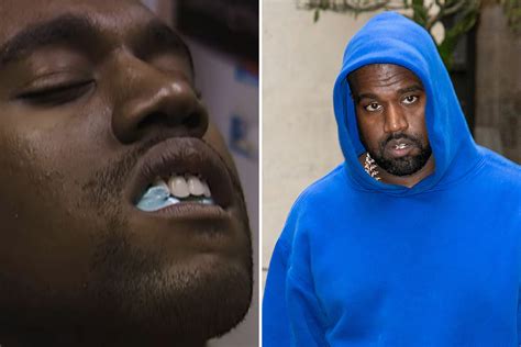 Kanye West Accident Face