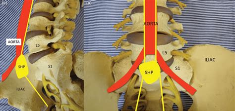 Superior Hypogastric Plexus Block | Anesthesia Key