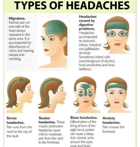 Headache diagram - Headache diagram causes - Fix | Headache types ...