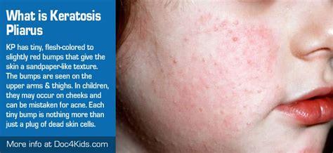 What is Keratosis Pliarus - Doc4Kids.com