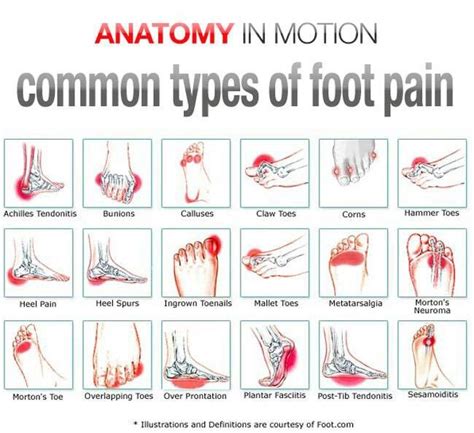 Anatomy Of Foot Pain - Anatomical Charts & Posters