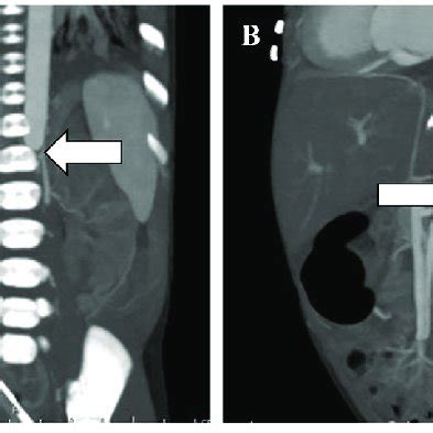 Intraoperative images of the abdominal aorta and aortic bifurcation.... | Download Scientific ...