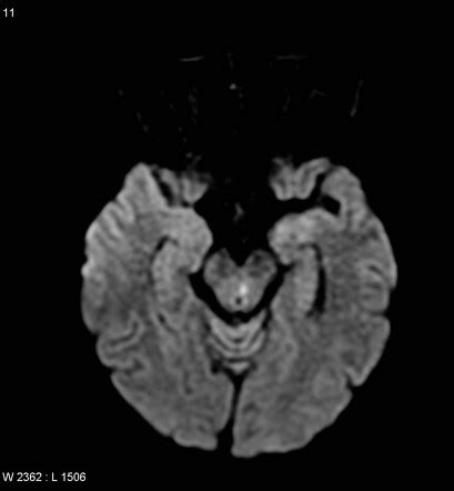 Internuclear Ophthalmoplegia Mri