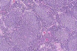 Follicular lymphoma - Libre Pathology