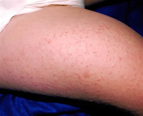 Keratosis Pilaris - Causes, Symptoms, How To Get Rid of It