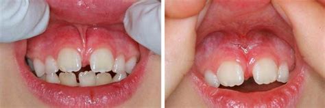 Mucogingival Treatment - Methuen Periodontics and Implant Dentistry