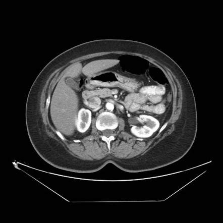 Pneumatosis cystoides intestinalis | Radiology Reference Article | Radiopaedia.org