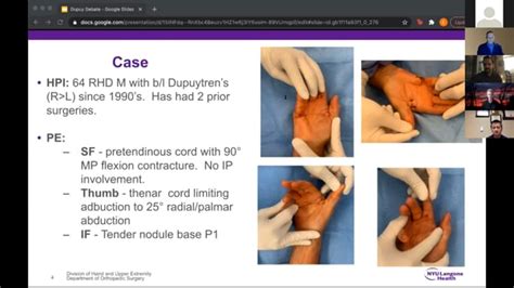 Dupuytren Disease: HERO | For Residents | Hand.e - ASSH