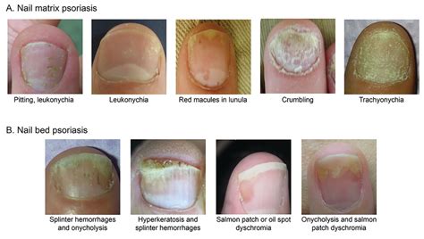 Onycholysis Psoriasis